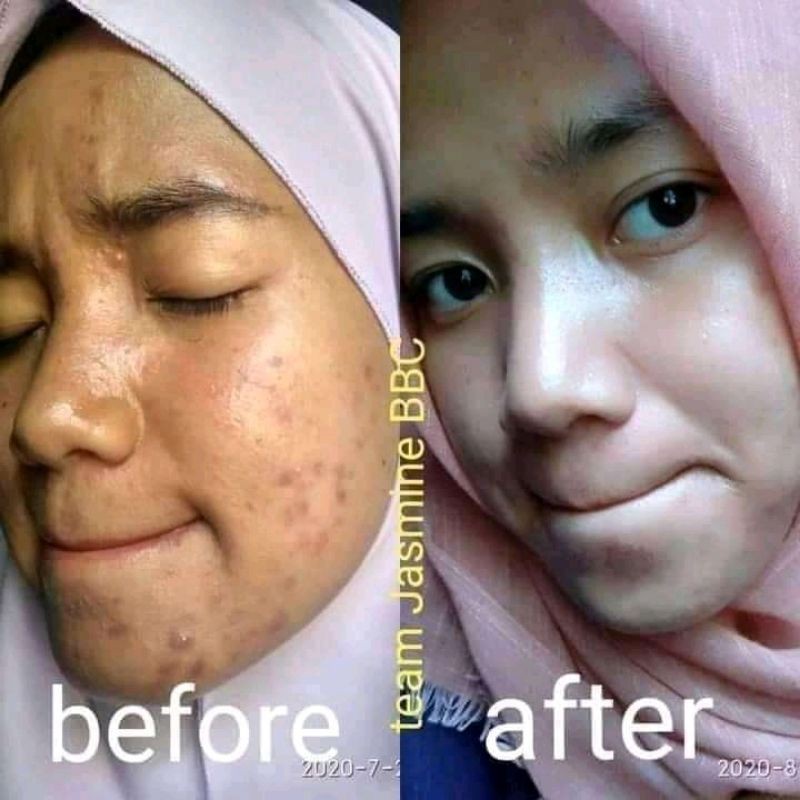 BBC ACNE