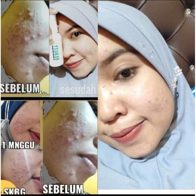 Serum jerawat paling ampuh