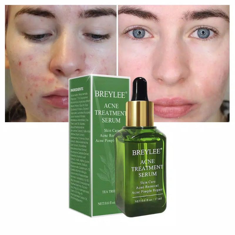 BREYLEE ACNE TREATMENT SERUM