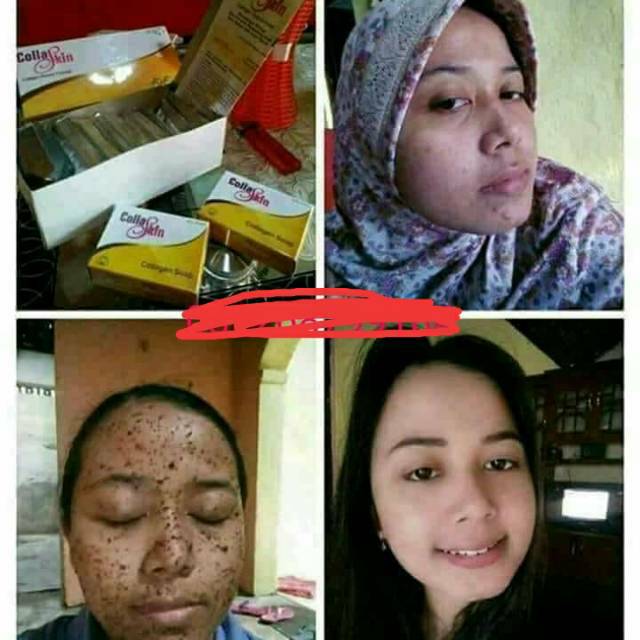 Collaskin