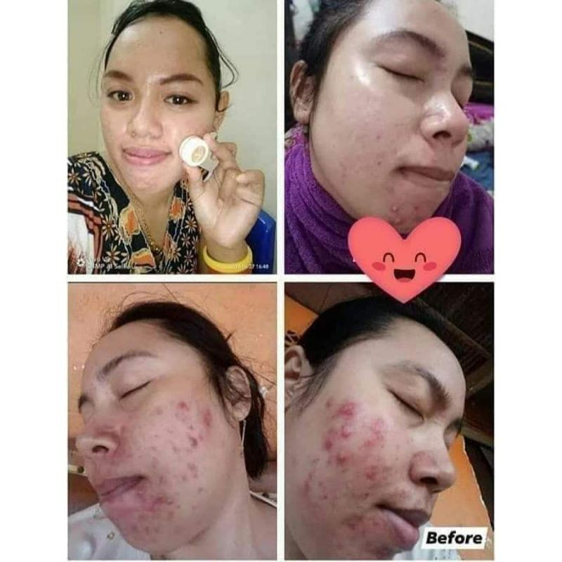 BEBWHITE C ACNE SERIES