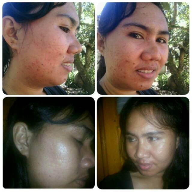 KRIM JERAWAT AMPUH