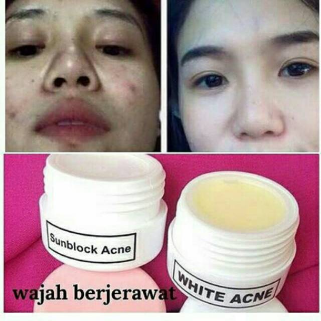 Paket acne white farma