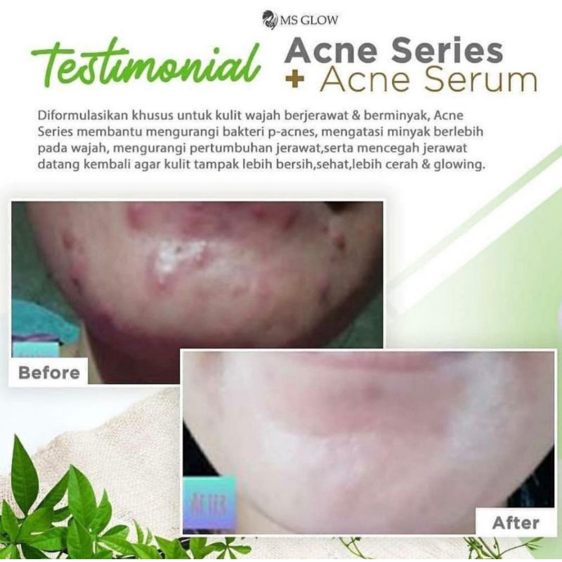 serum Acne (Ms Glow) 15ml