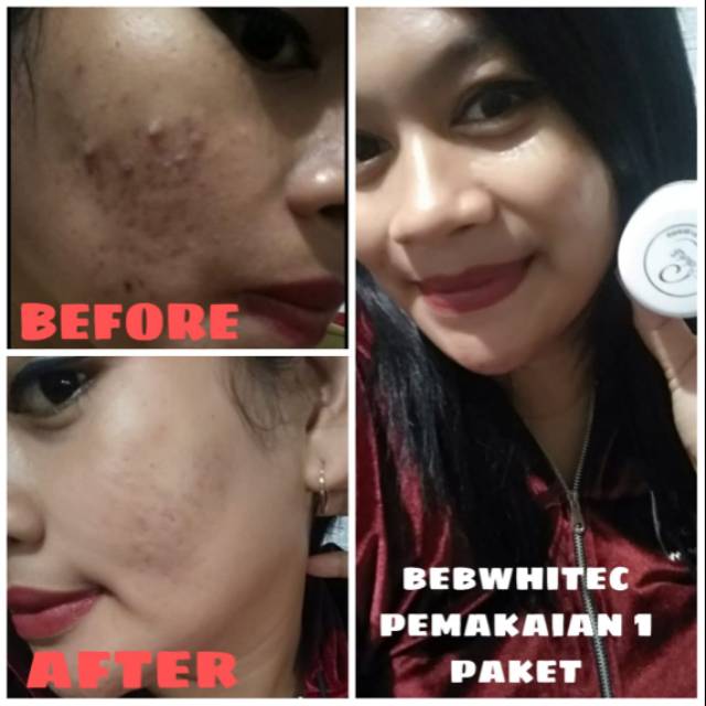 Bebwhitec paket acne dan glow