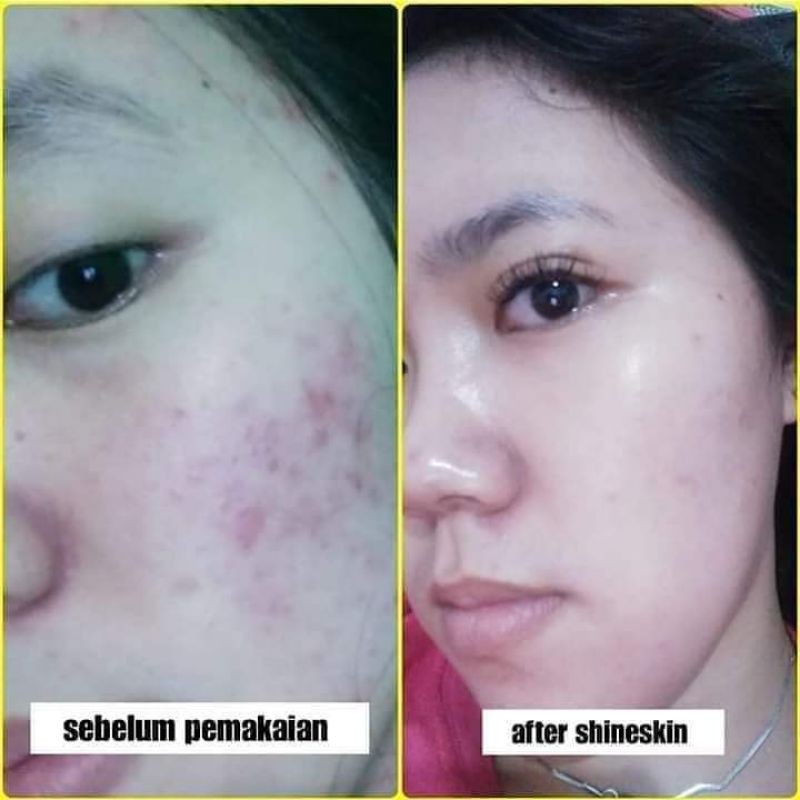 paket jerawat bekas jerawat