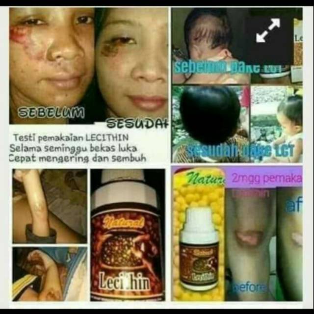 LECITH/LECITIN
