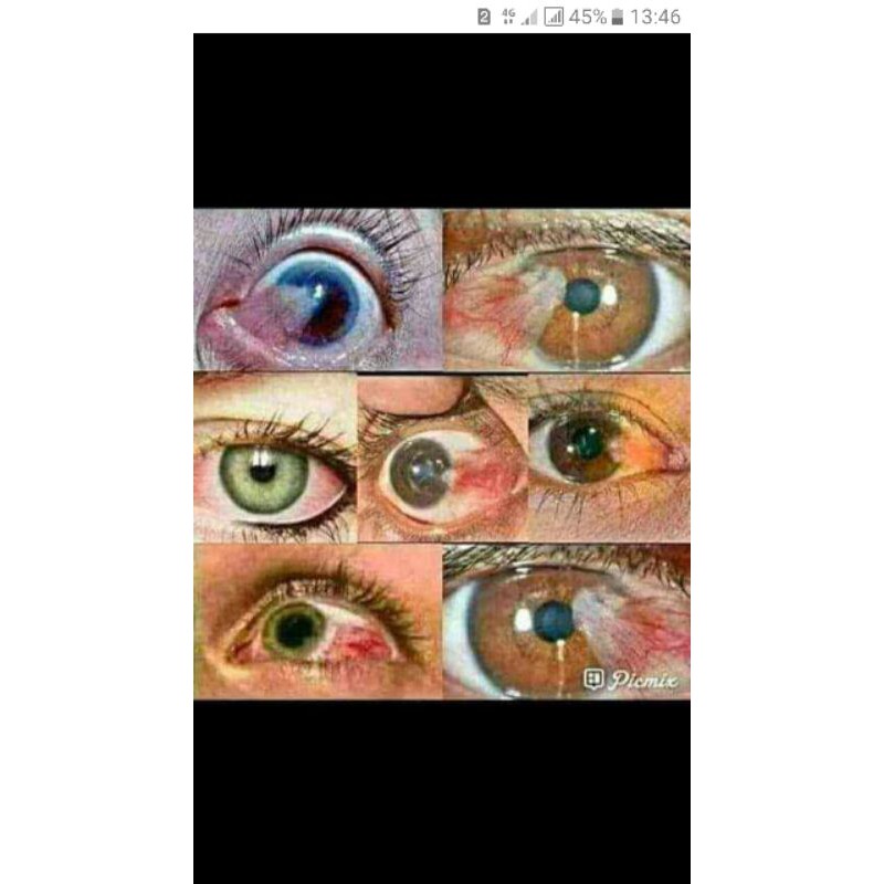OBAT MATA KATARAK , RABUN, MINUS, PLUS