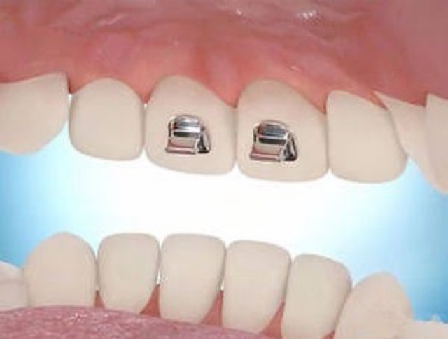 Orthodontic bite turbo isi 10