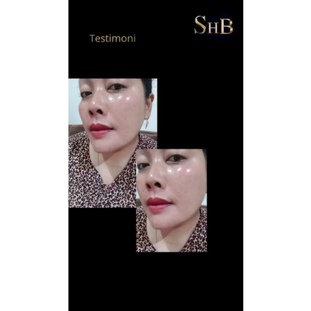 Super Strong Flek & Acne