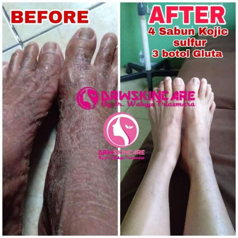 sabun Kojic sulfur DRW