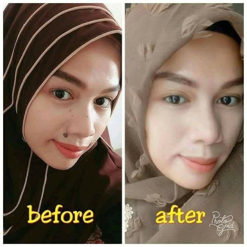 penghilang kutil