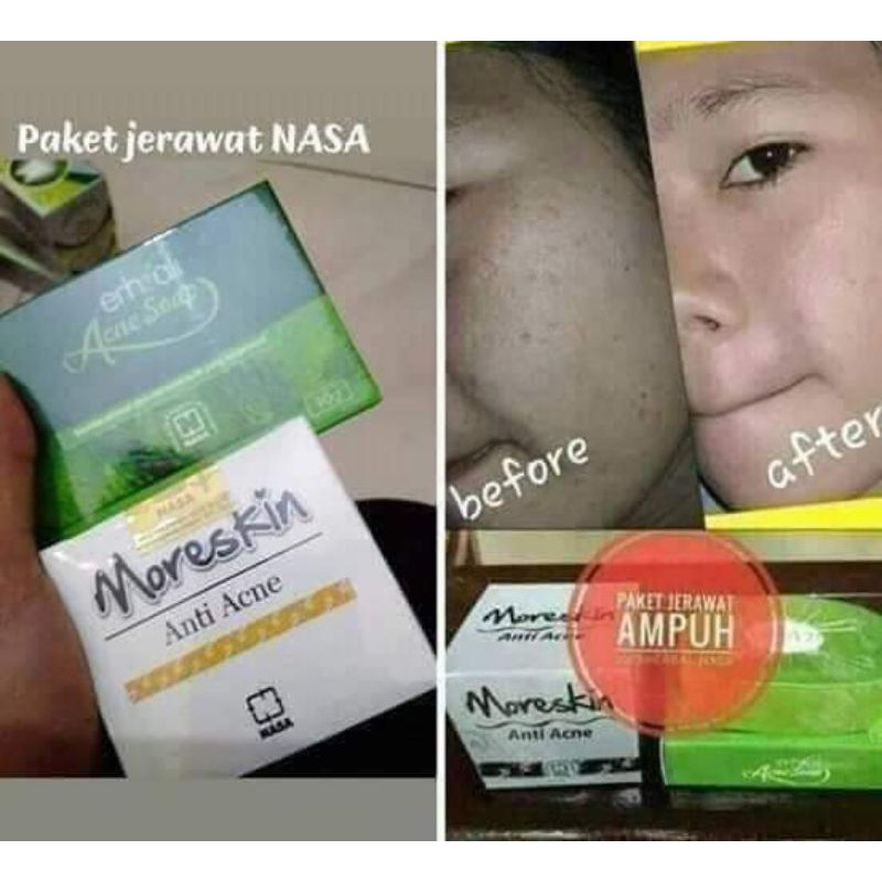 acnes