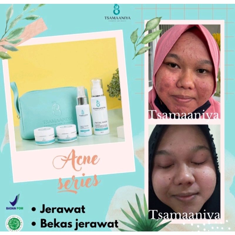 paket acne solution (basic) 15grm skincare Bpom jerawat ampuh (bisa cod)