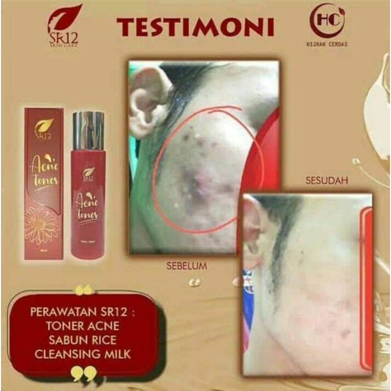 acne toner
