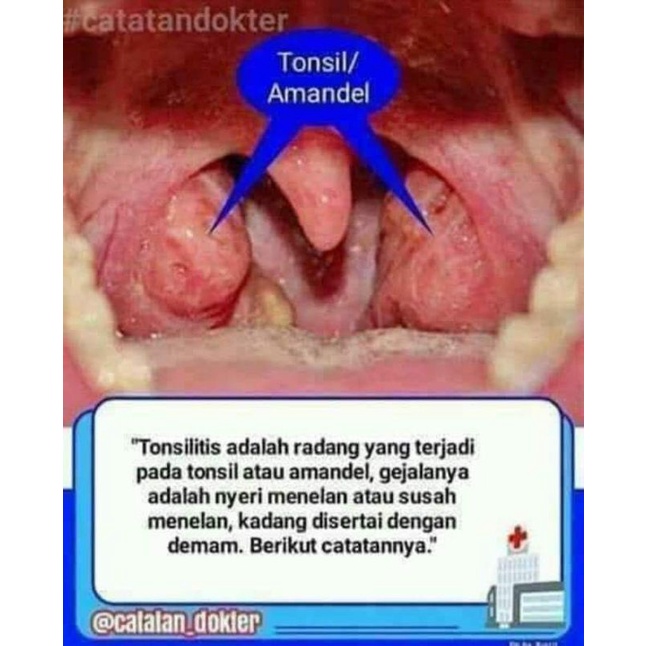 PAKET PENGOBATAN AMANDEL