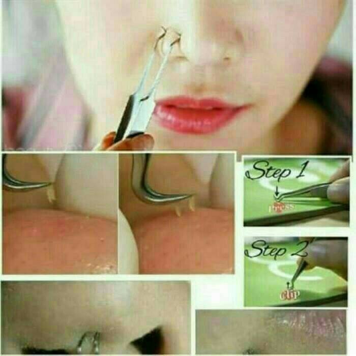 Pinset Komedo