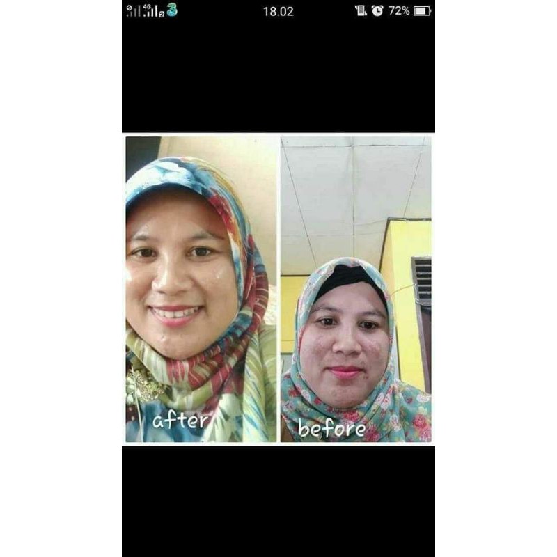 PAKET flek dan jerawat