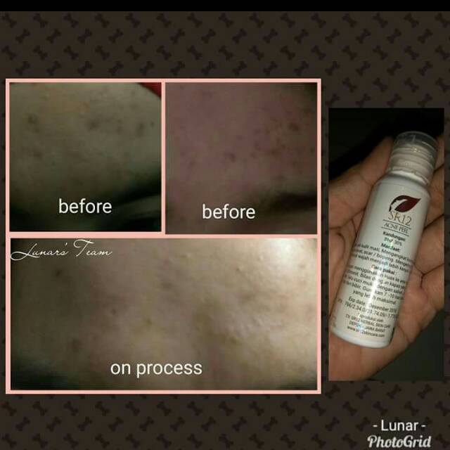 Acne Peel SR11