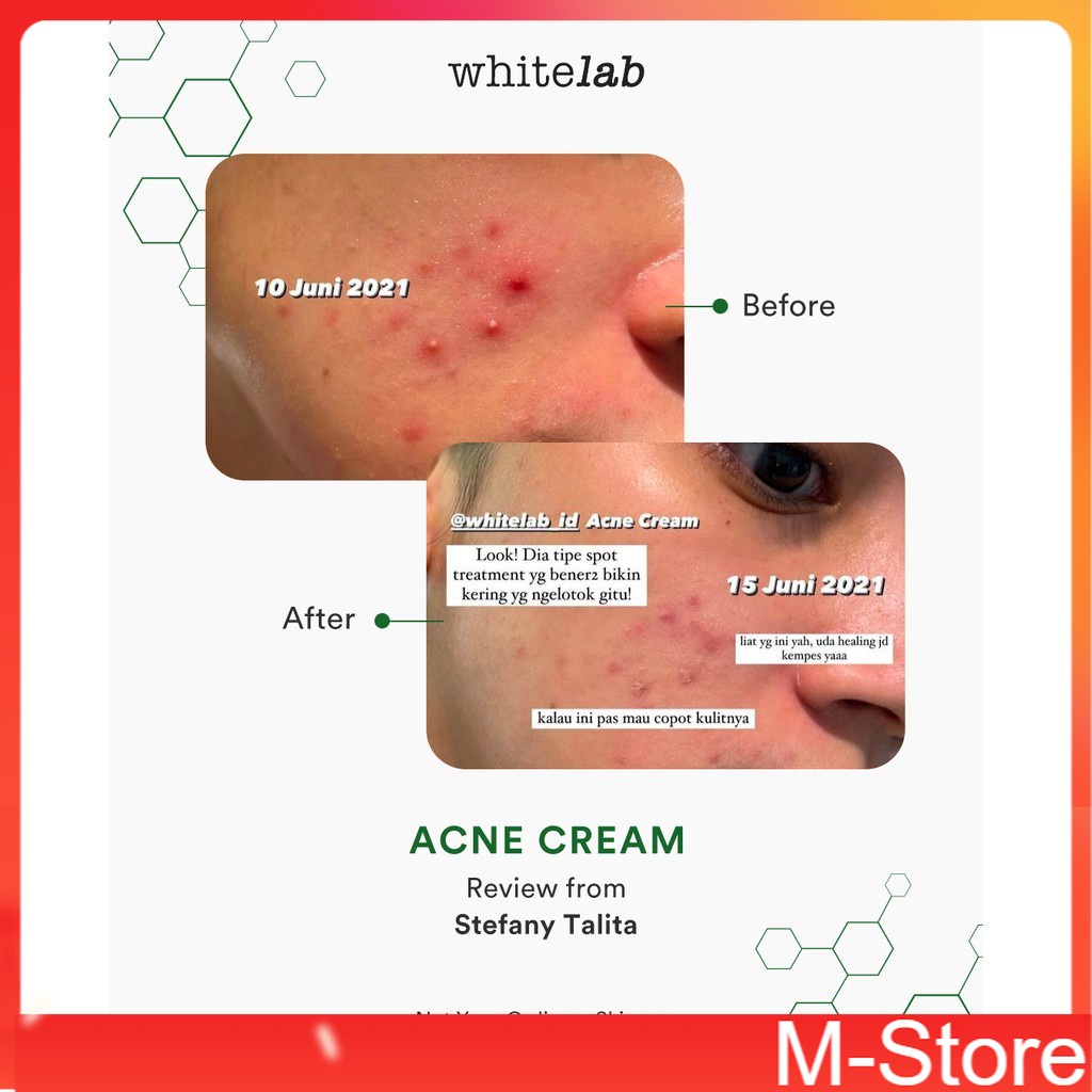 Whitelab -  Acne Cream