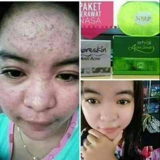 Paket jerawat nasa