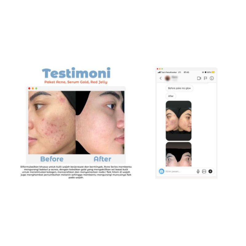MS GLOW ACNE SERIES