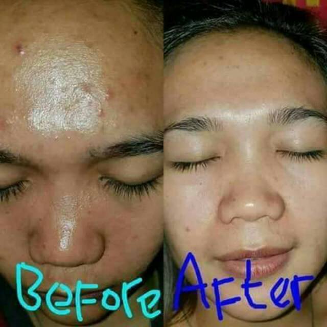 Acne glow series