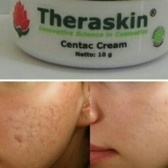 Centac cream theraskin