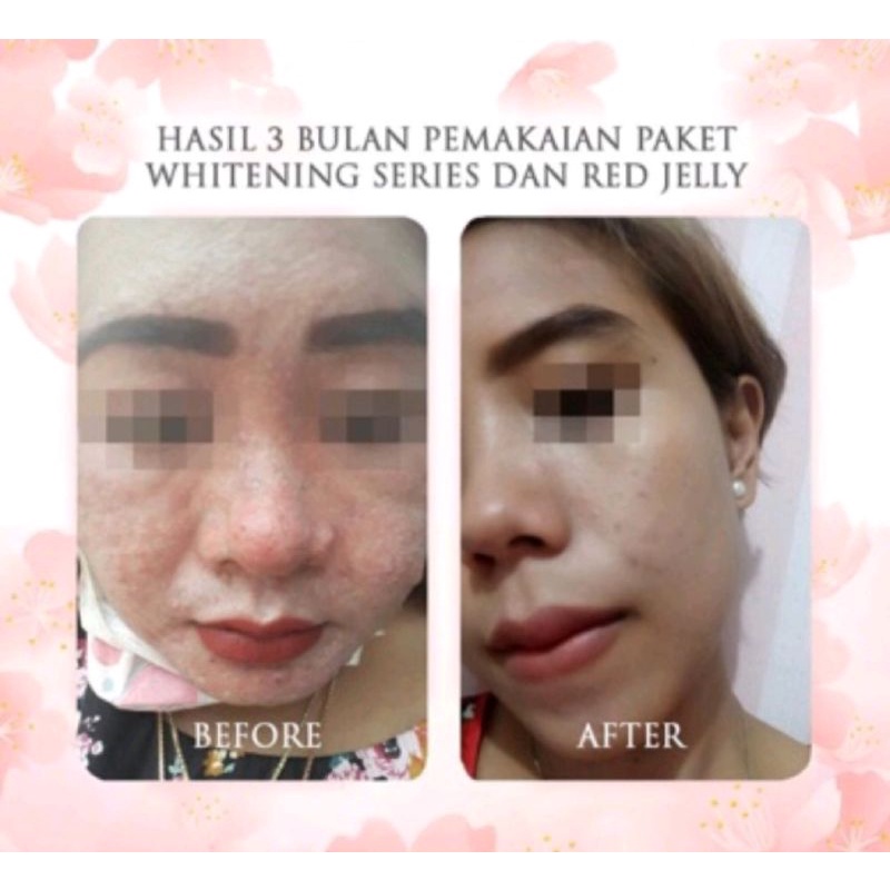 MSGLOW PAKET ACNE