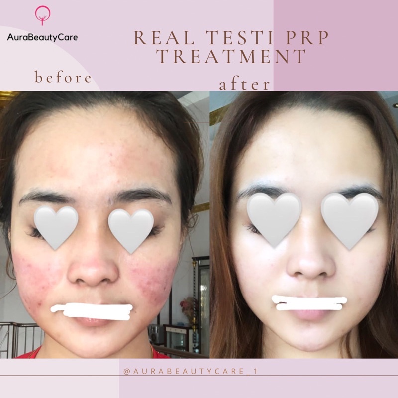 prp treatment