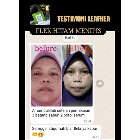 LEAFHEA HERBAL SEMBUHKAN FLEK HITAM