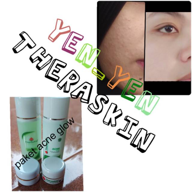 theraskin paket acne glow