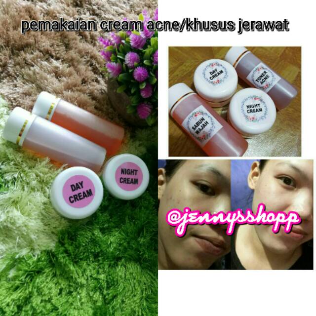 Cream acne/khusus jerawat