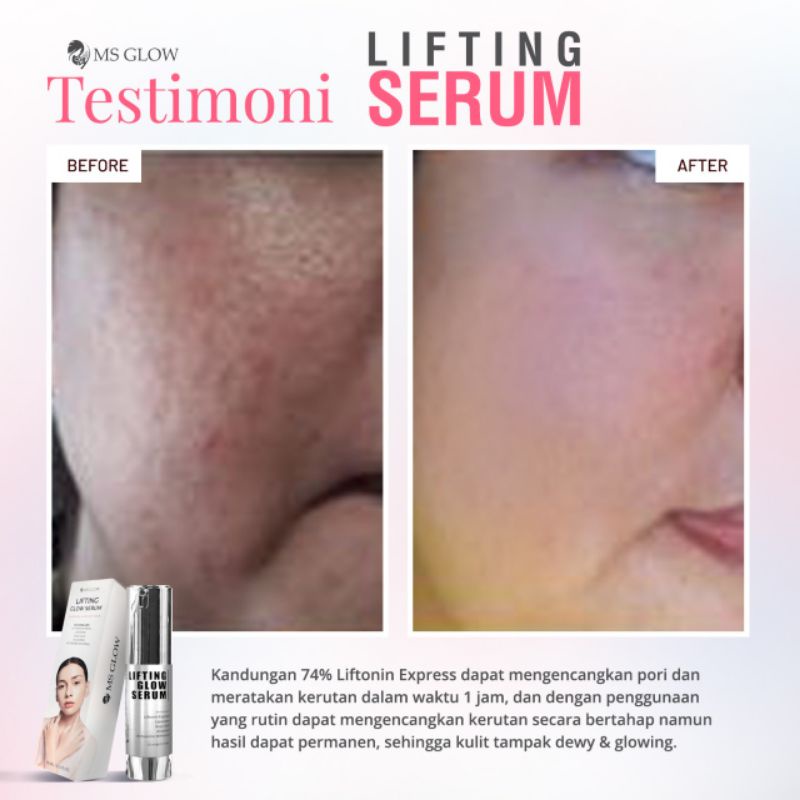 serum lifting