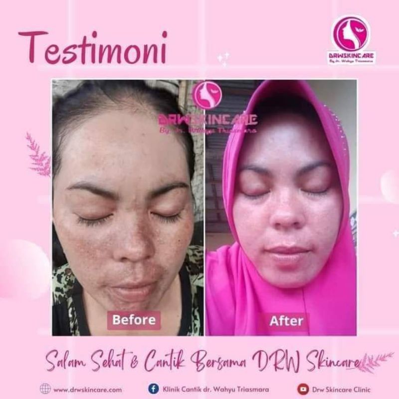 paket acne radiant brigthening