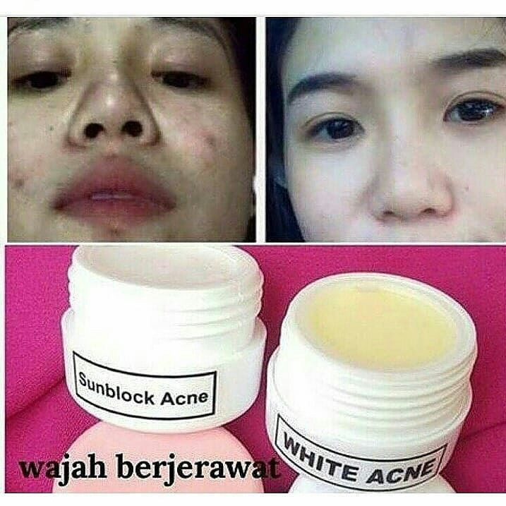 Farma wdc acne