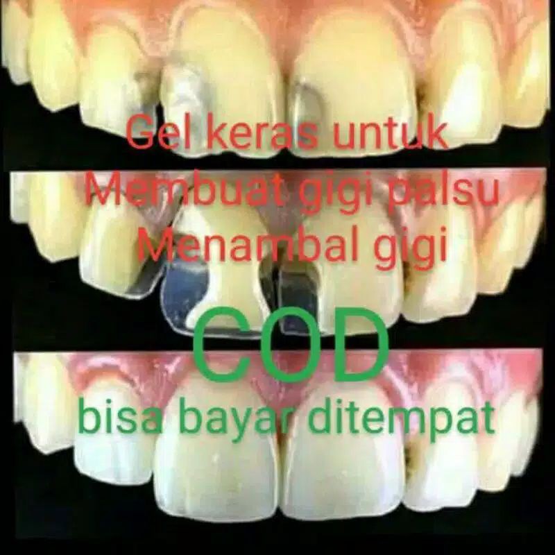 Tambalan gigi/tempthooth sementara