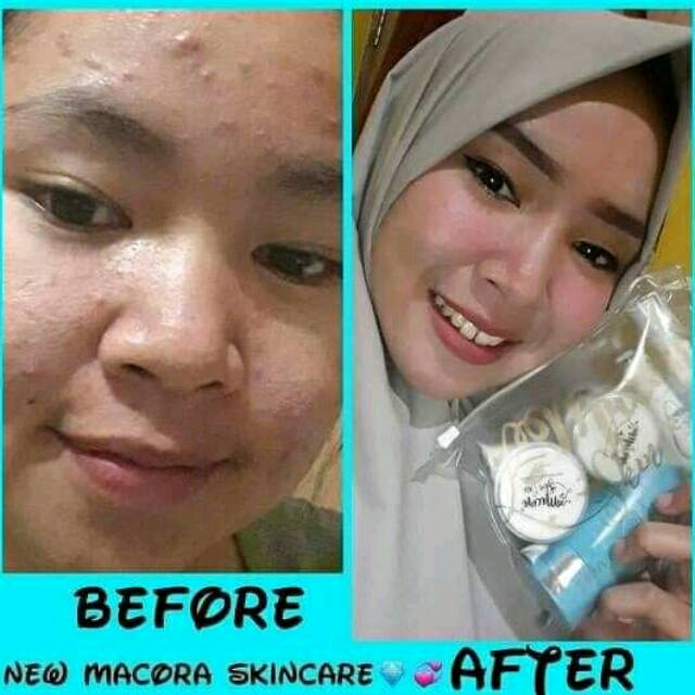 Macore skincare acne