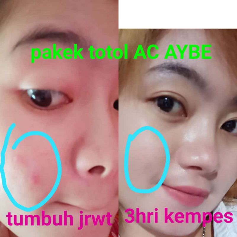 totol acne