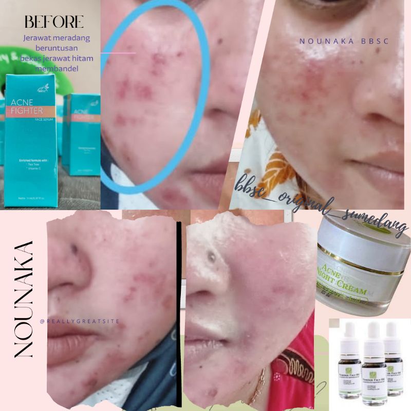 BBSC serum acne fighter
