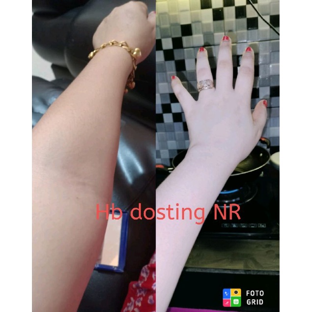 Hb dosting NR