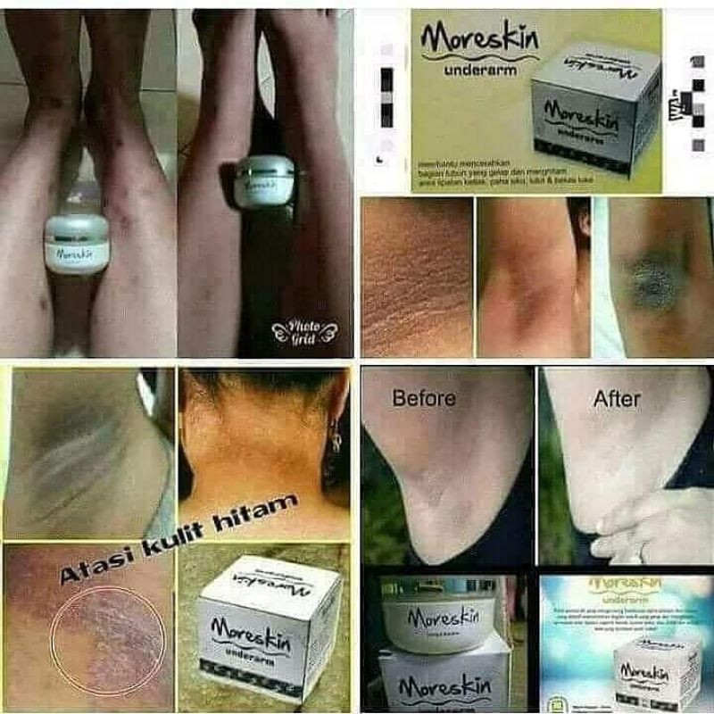 moreskin underarm