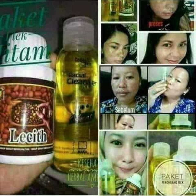 Penghilang flek hitam