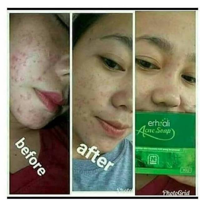 ERSHALI ACNE SOAP