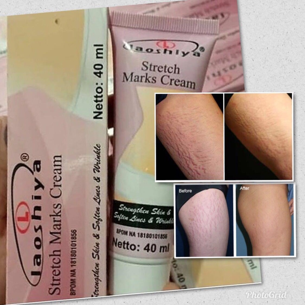 Laoshiya Stretch Marks Cream
