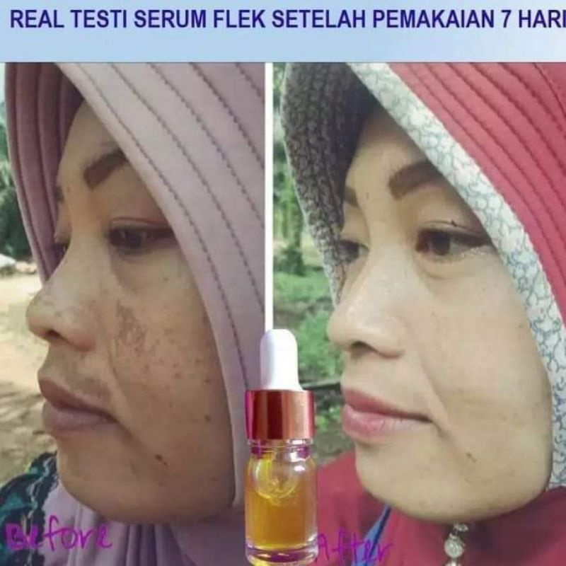 serum flek khusus flek berat