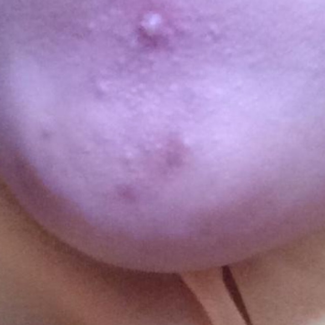 Jual jerawat
