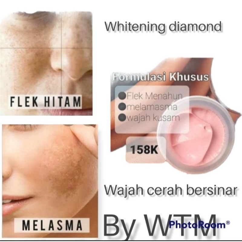crem Flek,melasma dan kusam