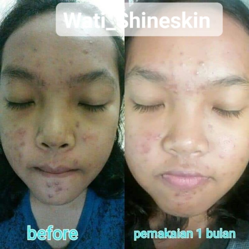 SHINESKIN PEKANBARU