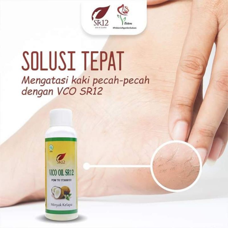 VCO SR12 solusi kaki pecah-pecah